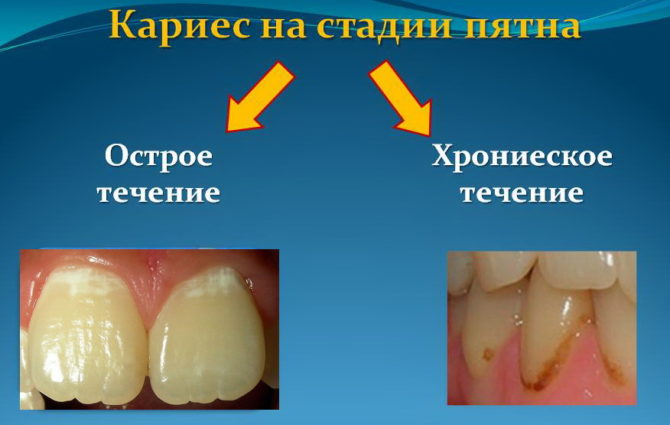 Zubní kaz v místě spotu