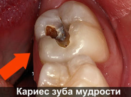 Zubní kaz osm