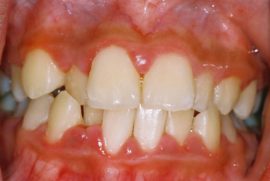 Catarrhal tandköttsinflammation