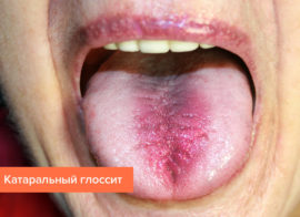 Katarrhalische Glossitis der Zunge