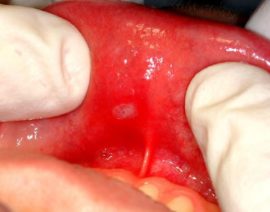 Catarrhal stomatitis