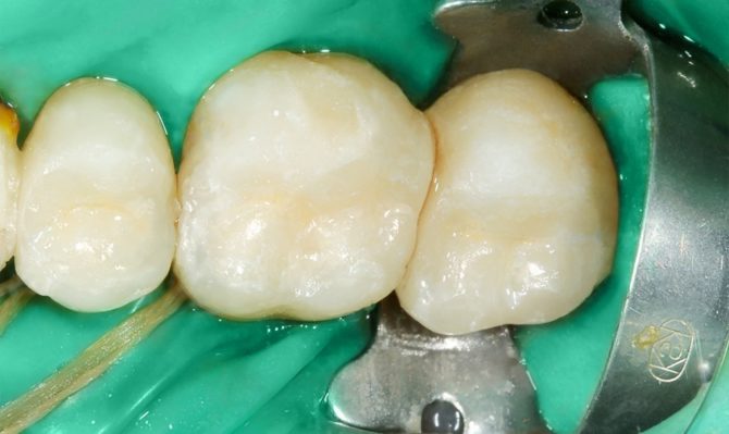 Kerámia töltelékek a gyógyított fogakon