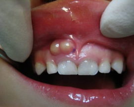 Cyst on the gum near the baby tooth