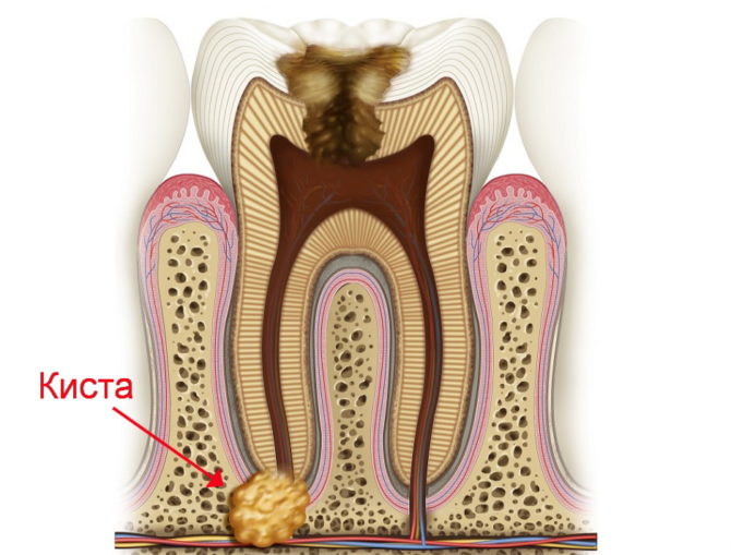 Cyst on the root of the tooth