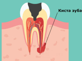 Cyst at the root of the tooth