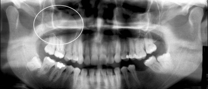 Chistul sinusal maxilar din imagine