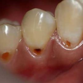 Klínový defekt na zubech
