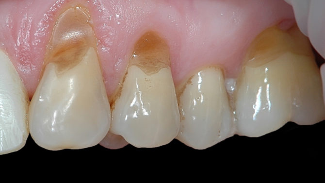 Дефект зуба у облику клина