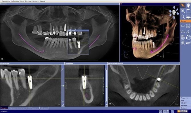 Tomografie computerizată a dinților