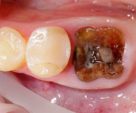 The root of the crumbling tooth inside the hole