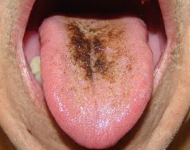 Braune Flecken auf der Zunge
