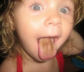 Braune Beschichtung auf der Zunge eines Kindes