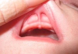 Kratka obloga gornje usne kod djeteta