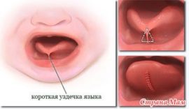 Short frenum of the tongue - operation