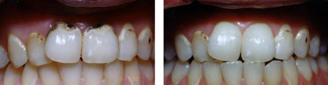 Zahnkorrektur mit Photopolymeren - vor und nach Fotos