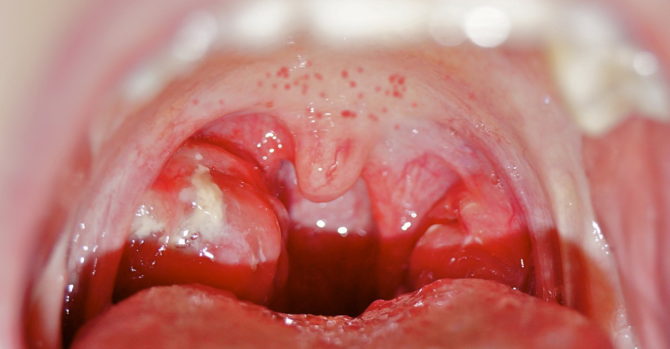Eruzione cutanea rossa in bocca