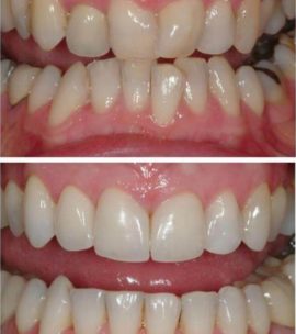 שיניים עקומות לפני יישור ואחריו