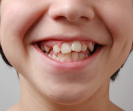 Dents tordues chez un enfant