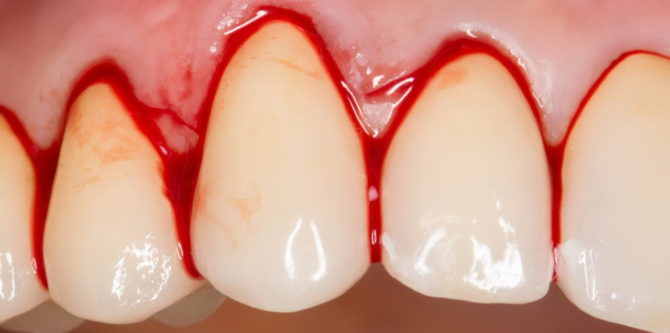Krvácející dásně