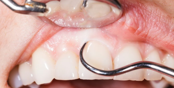 Curettasje av periodontale lommer