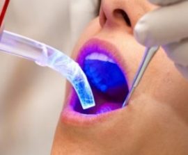 Lasersko izbjeljivanje zuba