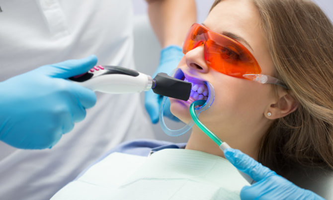 Laserové bielenie zubov