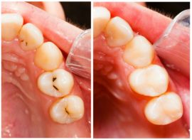 Penjagaan gigi untuk karies - sebelum dan selepas gambar