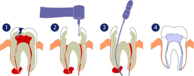 Léčba cyst na vrcholu kořene zubu