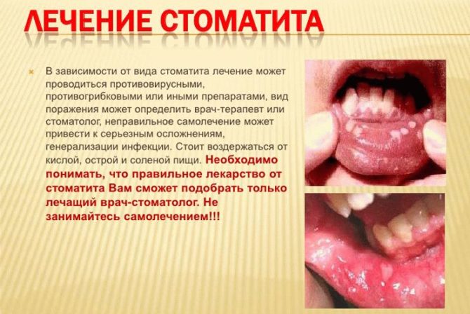 Léčba stomatitidy