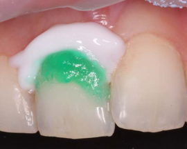 Zubné ošetrenie ICON