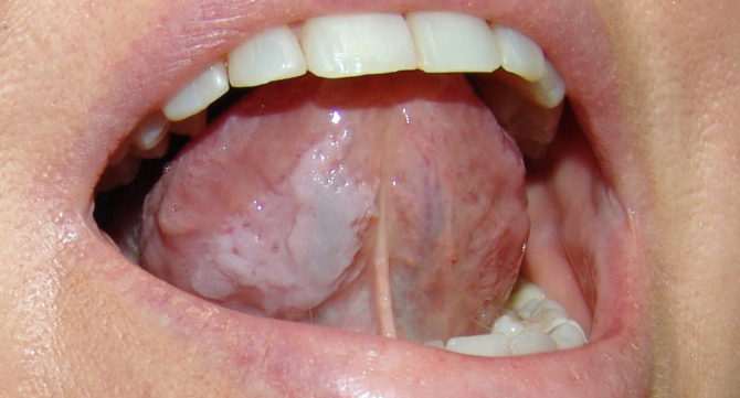 Orale Leukoplakie