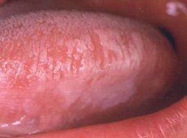 Leucoplasie de la langue