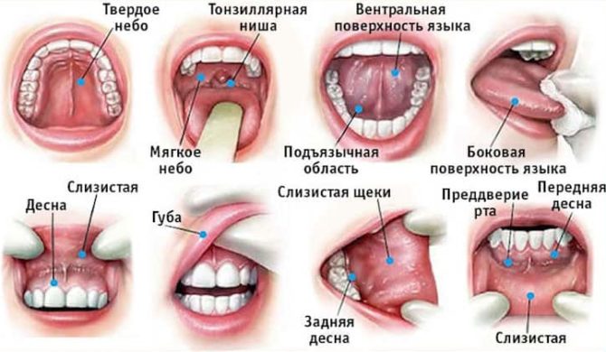Localizarea cancerului în cavitatea bucală