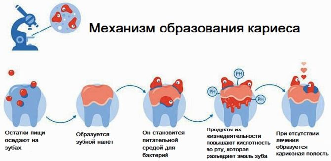 Mechanizmus tvorby zubného kazu