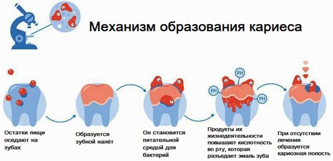 Mechanizmus tvorby zubného kazu