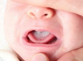 Grive de gravité modérée dans la bouche de l'enfant