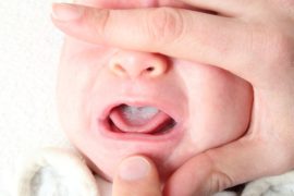 Thrush in a child's mouth