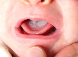 Aftas en la boca del niño