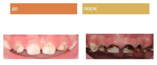Mliječni zubi prije i nakon srebrnjanja