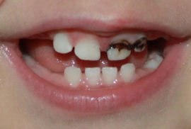 Milk teeth after silvering