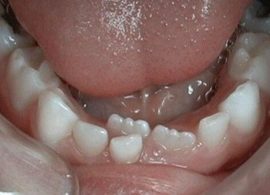 Leite e dente permanente