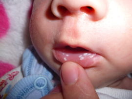 Bệnh tưa miệng ở trẻ