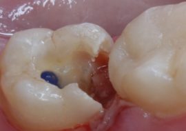 Arsénico en el diente