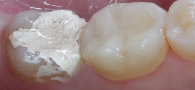 Arsênico em um dente abaixo de um recheio temporário