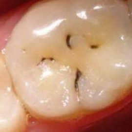 Giai đoạn ban đầu của sâu răng