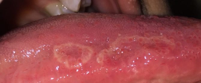 Initial Stage of Tongue Cancer