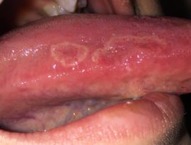 La etapa inicial del cáncer de lengua.
