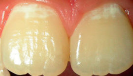 Caries dental inicial
