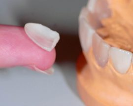 Recubrimiento dental frontal