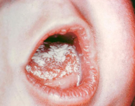 Plaque sur la langue du bébé avec muguet de la cavité buccale